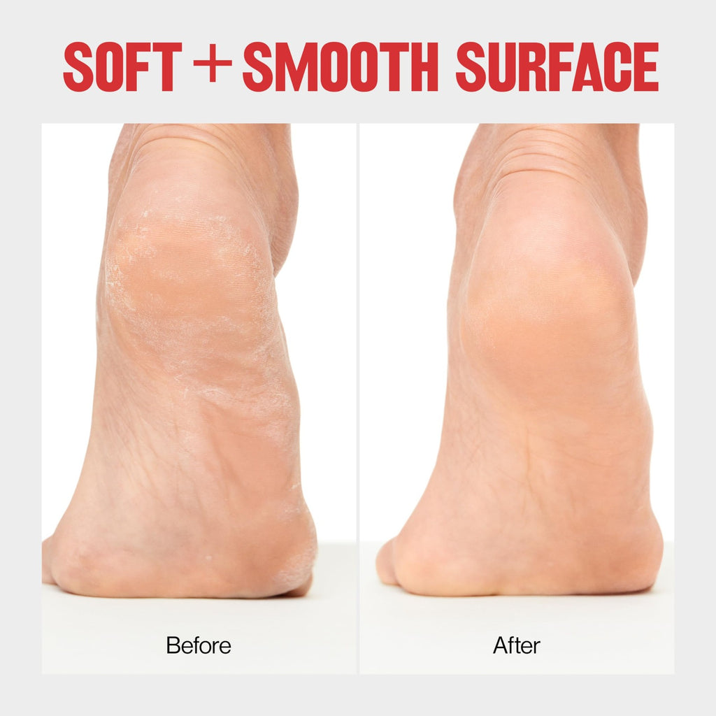 Callus Remover by Revlon, Foot File for Wet or Dry Skin, Pedicure Tools,Gently